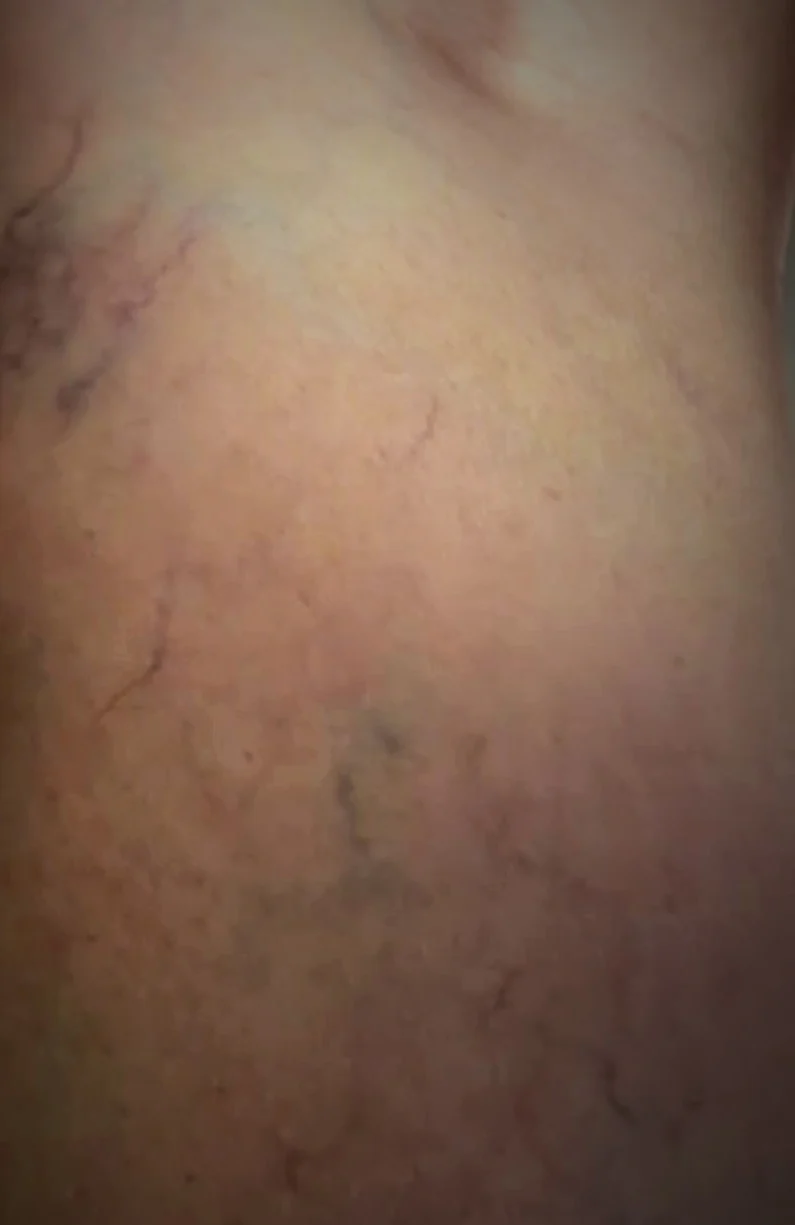 Close-up of a leg showing a cluster of spider veins before treatment