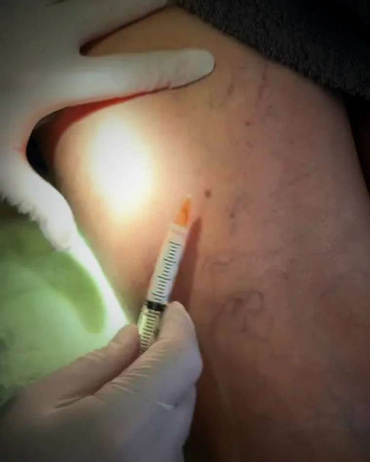 Gloved hands treating a vein under a clinical examination lamp