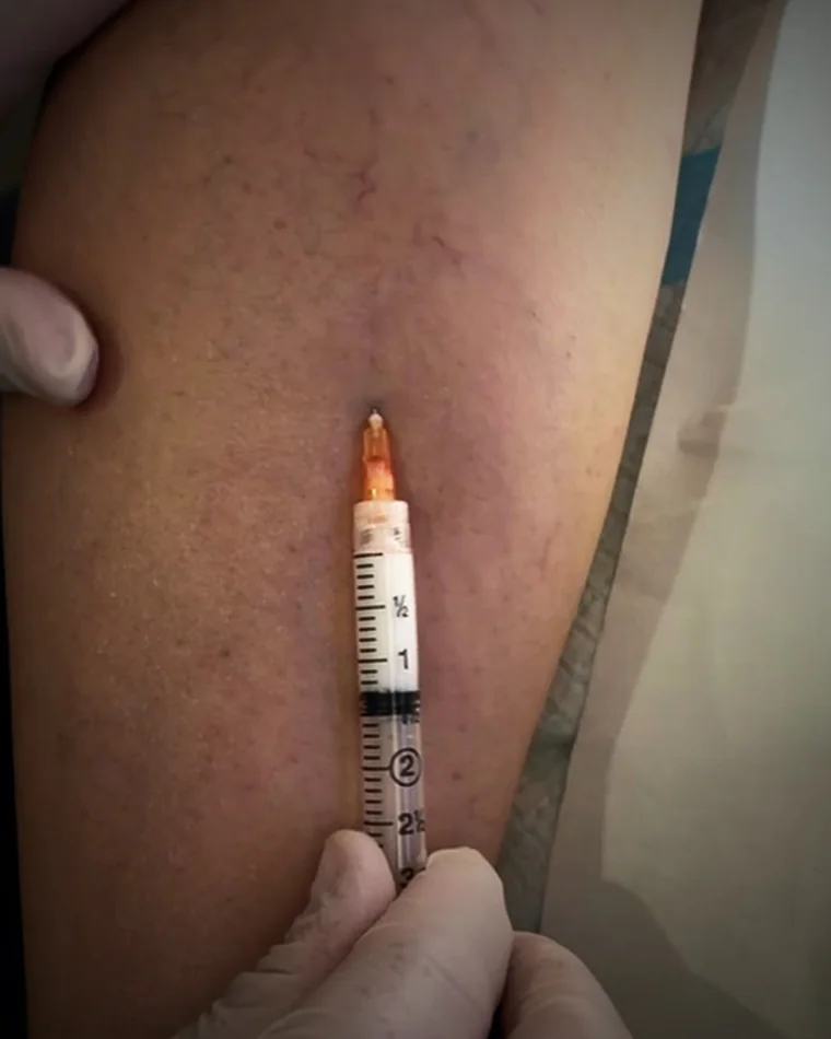 A fine graduated syringe held against the leg during sclerotherapy