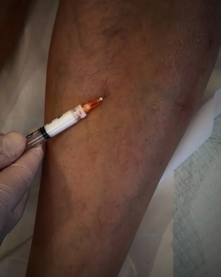 A leg with visible varicose veins before injection treatment